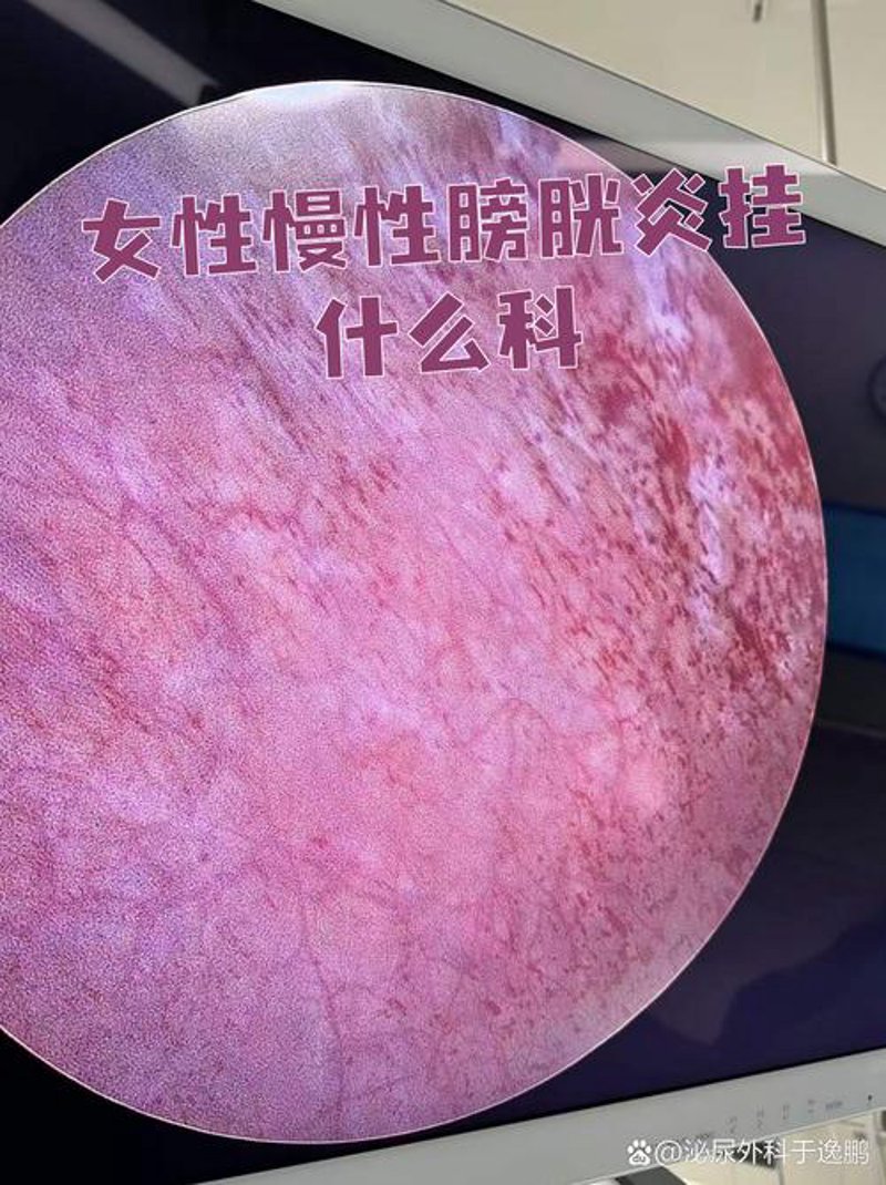 尿道炎：了解与防治的最新进展