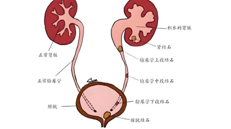 泌尿感染